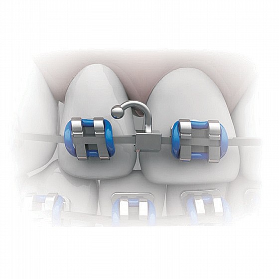 ���� ����������� ������� �����  Morelli Dental Orthodontic Crimpable Split Hooks Left Special Curved Ball Tip 