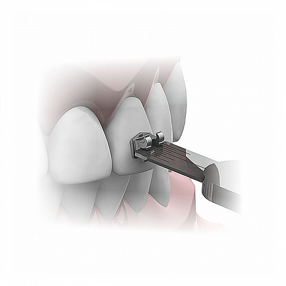 ������ ���������� �� ����� Morelli Orthodontic Tweezer 