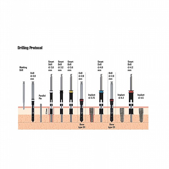 ��� ����� ������ DSI Spiral Smart Dual Thread Implant 