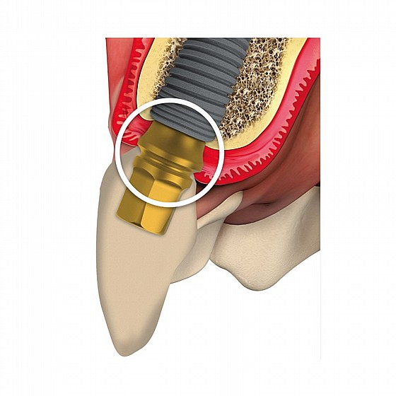 ���� ������ ������ ���� DSI Snap-On Concave Anatomic Impression Transfer 1.5-4.5mm