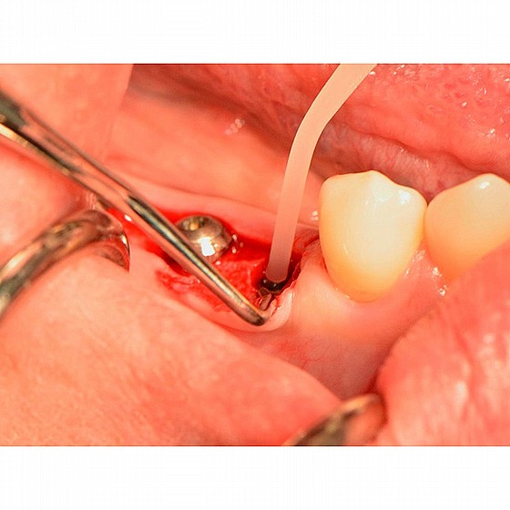 ���-��� �� ���� ���� HAGER GAPSEAL Dental Implant Anti Bacterial Peri-implantitis