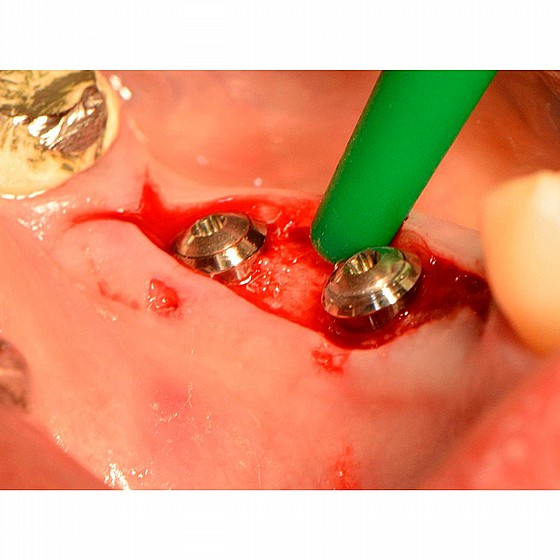 ���-��� �� ���� ���� HAGER GAPSEAL Dental Implant Anti Bacterial Peri-implantitis