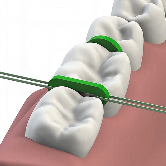 ������� ������� 1000 �� Morelli Separators Elastics