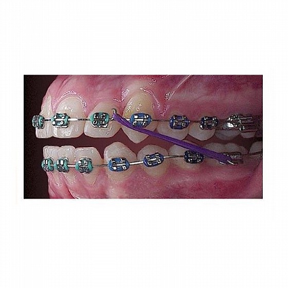 ������ ��� ������ ������� ����� �� ���� Magic Intraoral Latex Elastics