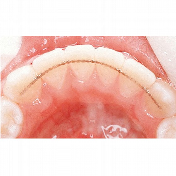 ��� ����� ������ ����� ��� ��� 14K ���� �� 76 �"� Ortho Flextech White Gold Retainer Wire