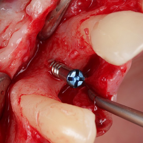 ���� GBR TENT SCREW ������� ������ + ������ ������� Bionnovation Biomedical MESH 