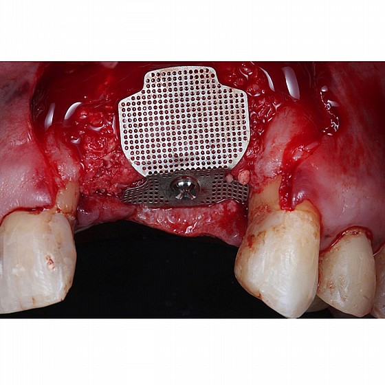 ���� GBR TENT SCREW ������� ������ + ������ ������� Bionnovation Biomedical MESH 