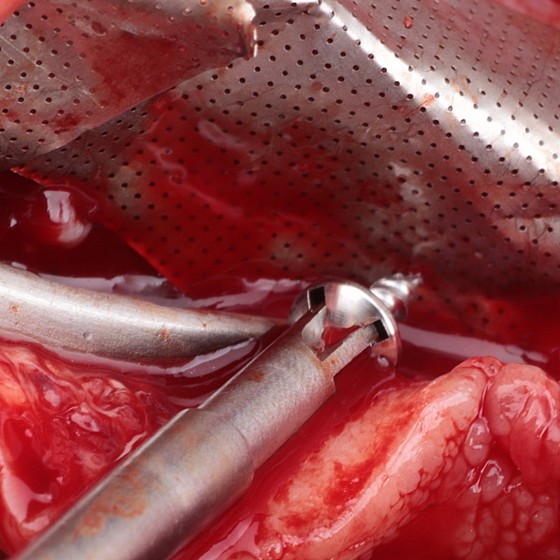  ������ ������� �������� ��������� Bionnovation Biomedical Mesh Plate GBR