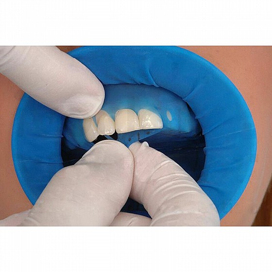 ���� �� �� ��� ���� ����� Disposable Lip Retractor And Dental Dam