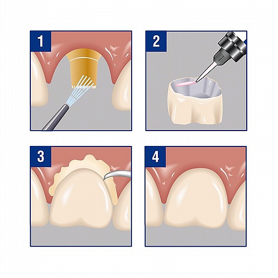 ��� ����� ����� 8.6 ��� DSI IMPLANT CEMENT