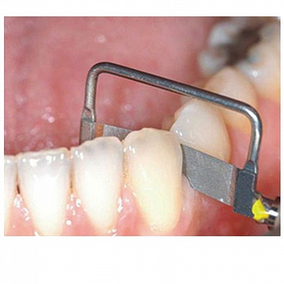���� ������ ����� �������������� ����������� DSI IPR PROXISTRIP INTERPROXIMAL REDUCTION