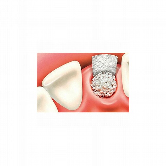 ��� ������� ������ �������� DSI SYNTOSS BONE GRAFT GRANULES