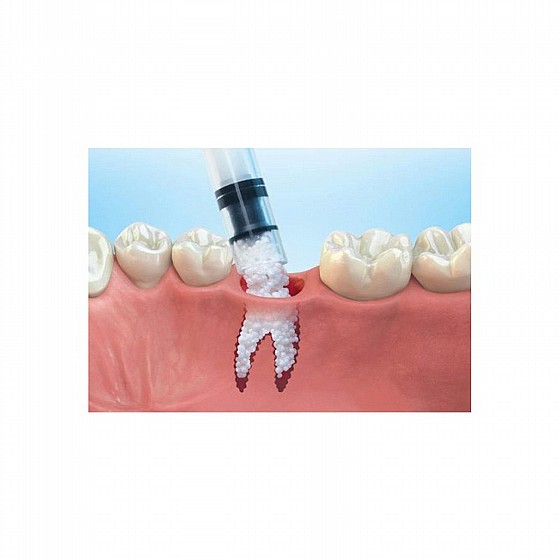 ��� ������� ������ ���� ����� DSI SYNTOSS PLUS BONE GRAFT IN SYRINGE