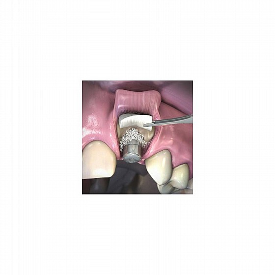 ������ ������� ������ ��� ���� DSI SYNTOSS BIO+ COLLAGEN MEMBRANE