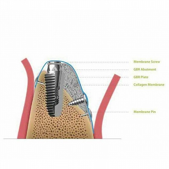 ���� ����, ������� ������ ������ ��.��.�� DSI GBR SURGICAL SCREW KIT