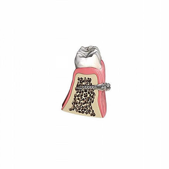 ����� ��� ���������� ������ DSI TAD Orthodontic Mini Implant Screw Absolute Anchorage