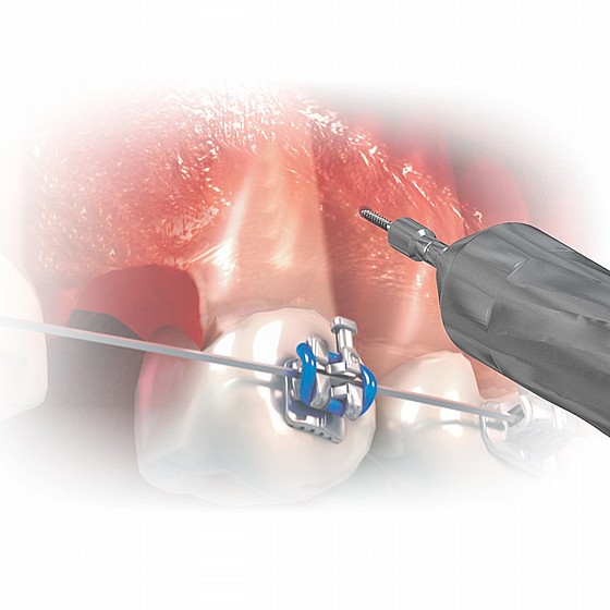 ����� ��� ���������� ������ DSI TAD Orthodontic Mini Implant Screw Absolute Anchorage