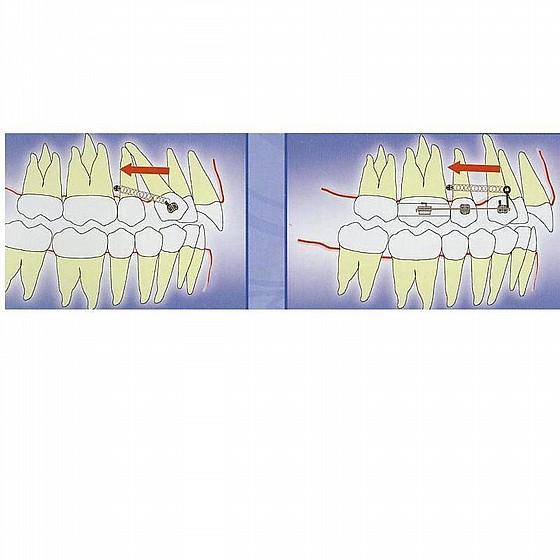 ����� ��� ���������� ������ DSI TAD Orthodontic Mini Implant Screw Absolute Anchorage