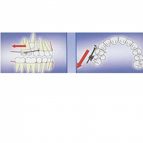 ����� ��� ���������� ������ DSI TAD Orthodontic Mini Implant Screw Absolute Anchorage