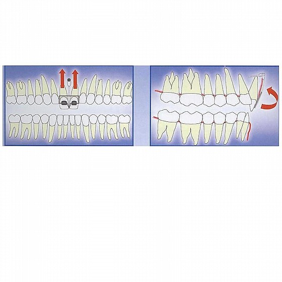 ����� ��� ���������� ������ DSI TAD Orthodontic Mini Implant Screw Absolute Anchorage