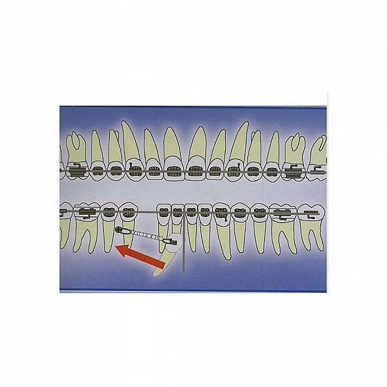 ����� ��� ���������� ������ DSI TAD Orthodontic Mini Implant Screw Absolute Anchorage