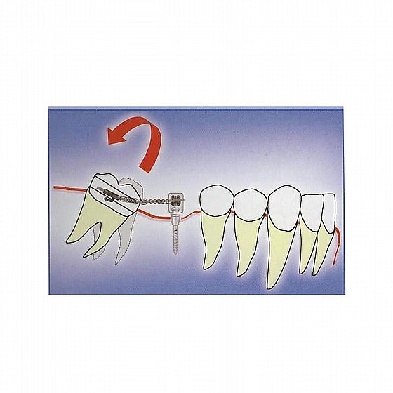 ����� ��� ���������� ������ DSI TAD Orthodontic Mini Implant Screw Absolute Anchorage