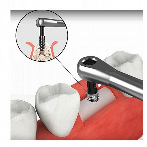 ���� ����� ������ ������ DSI SOS Broken Screw Extractor Total Remove Kit