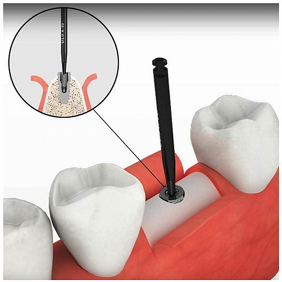 ���� ����� ������ ������ DSI SOS Broken Screw Extractor Total Remove Kit