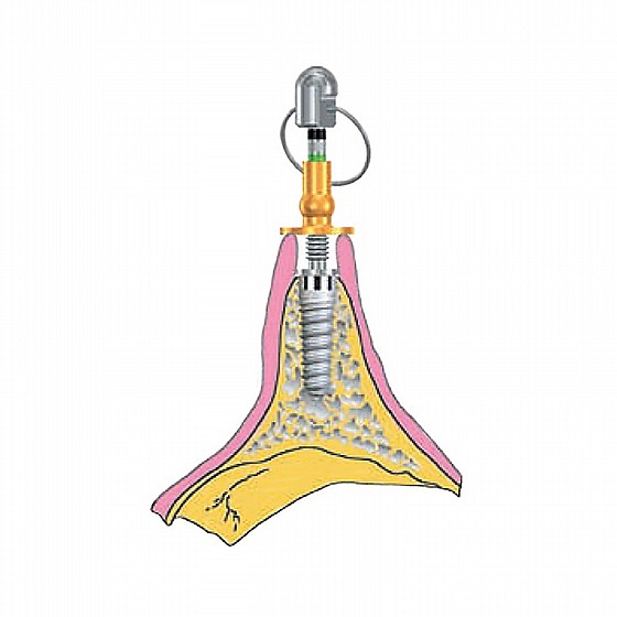 ���� ������ ���� ������� Rhein83 Gingiva Cuff Height Measure Kit