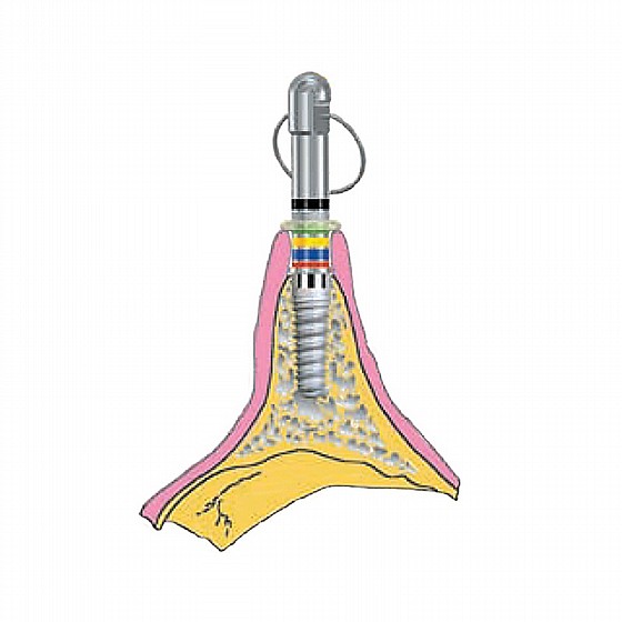 ���� ������ ���� ������� Rhein83 Gingiva Cuff Height Measure Kit