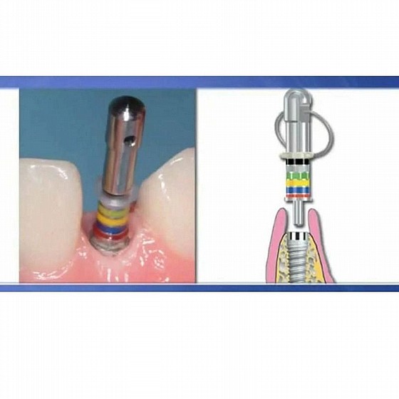 ���� ������ ���� ������� Rhein83 Gingiva Cuff Height Measure Kit