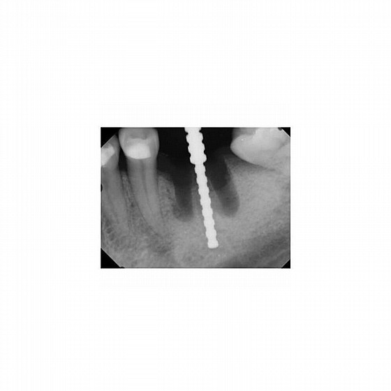 ��� ������ �������� DSI Jag Parallel Guide Pins