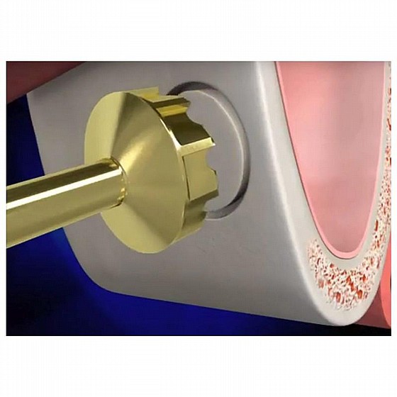 ���� ���� ����� ����� DSI Sinus Lifting Lateral Approach Side Cutter