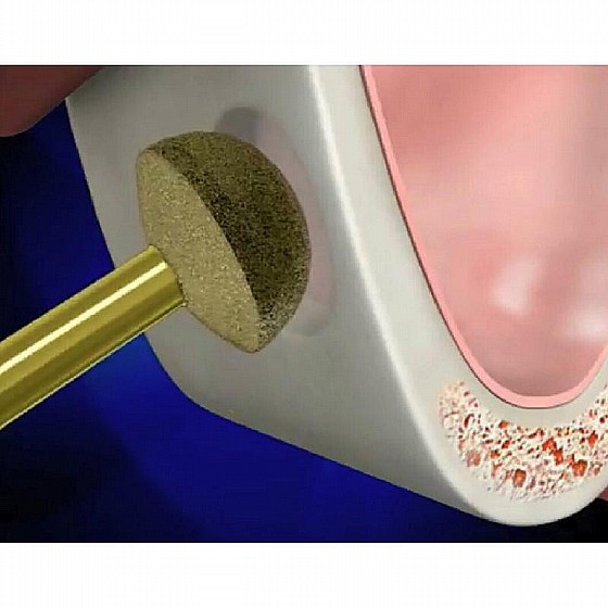 ���� ����� ����� ����� DSI Sinus Lifting Lateral Reamer Drill