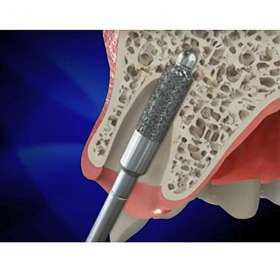 ���� ������� ������� ����� ����� DSI Top Drill Sinus Lifting Diamond Bur