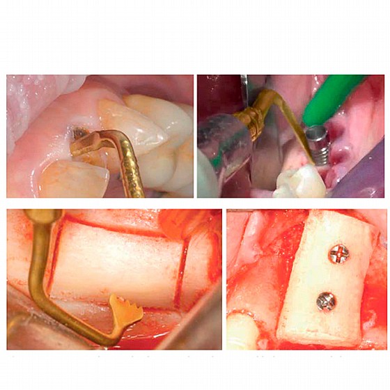 ����� ������������ �������� �� ������� �� ��� MARIOTTI PIEZOELECTRIC SURGICAL UNIT