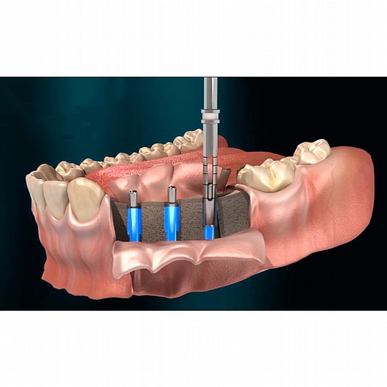 ����� ����� ������ ����� DSI Smart Trephine DNT Coated Surgical Drills