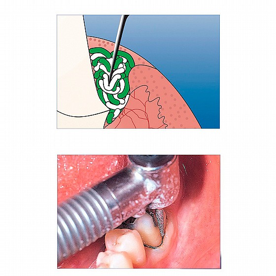 ��� ������� �� ��������� ���� 285�� DSI DS-Cord Gingival Retraction Cord With Epinephrine