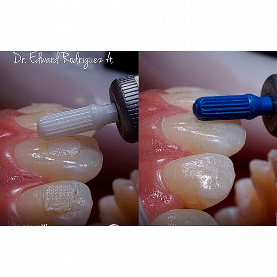 ���� �������� ����� ��� ������ DSI Debonding Zirconia Bur for Bracket Adhesive Removal  	