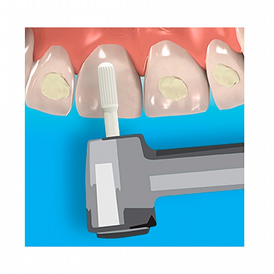 ���� �������� ����� ��� ������ DSI Debonding Zirconia Bur for Bracket Adhesive Removal  	