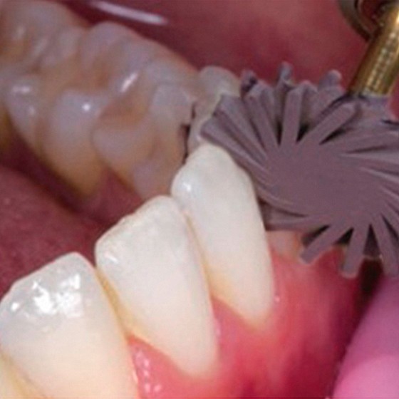 �� ������ ������ ������ ������ ����� ���� DSI Abrasive Disc Polishing EVE TWIST