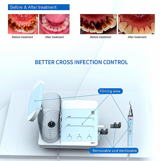 ����� ���� ����� ���� ����� �� LED ����� ��� ����� Ultrasonic Scaler Maxipiezo