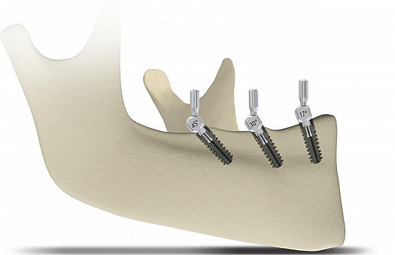 ��� �� ����� ������ Implant Angulation Gauge Clip