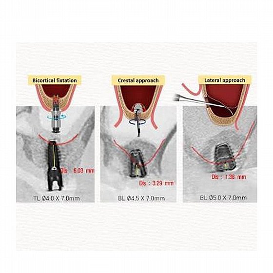 ���� ���� ���� ������ ����� ���� ����� Dentium DASK Simple Sinus Kit