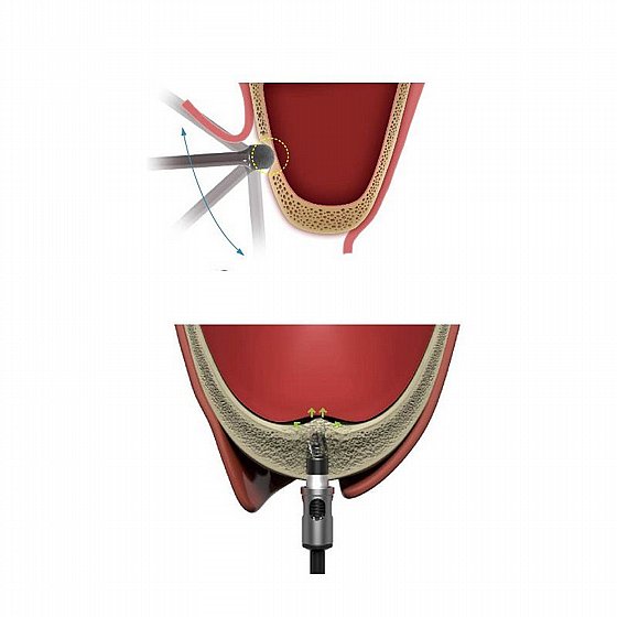 ���� ���� ���� ������ ����� ���� ����� Dentium DASK Simple Sinus Kit