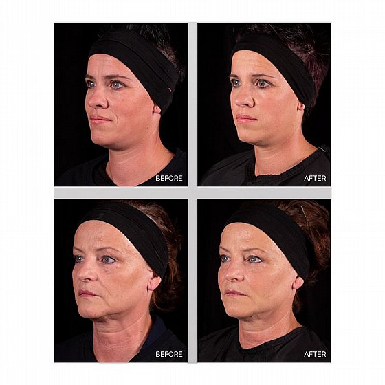 ����� ���������� ������ �������� ������� HA: �20 mg/ml Radiant Soft Fillers