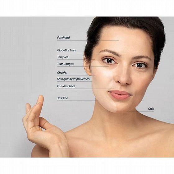 ����� ���������� ������ �������� ������� HA: �20 mg/ml Radiant Soft Fillers