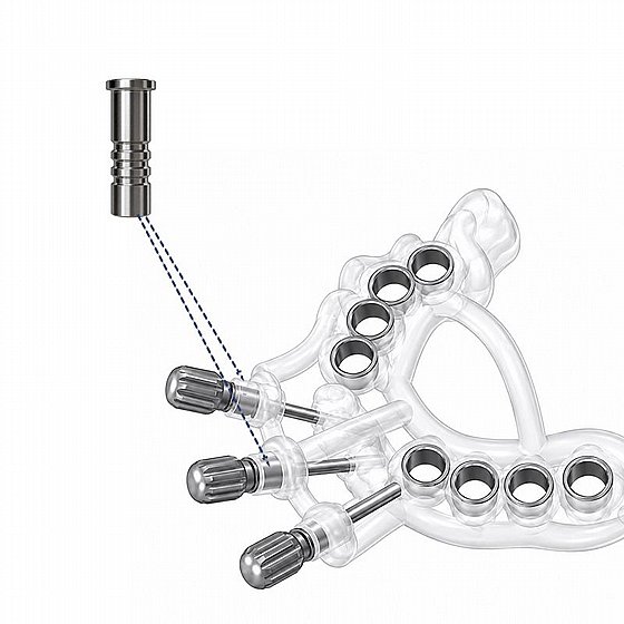 ����� ���� ����� �� ���� ������� ?1.6 �"� DSI Surgical Guide Fixation Pin Sleeve