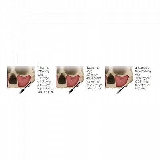 ��� ������ ������� JDPterygo Drills Kit
