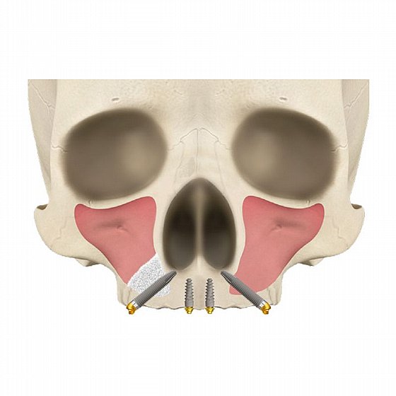 ��� ��������� ?4.0 �"� ����� ����� ����� ���� ������  JD JDNasal Implant